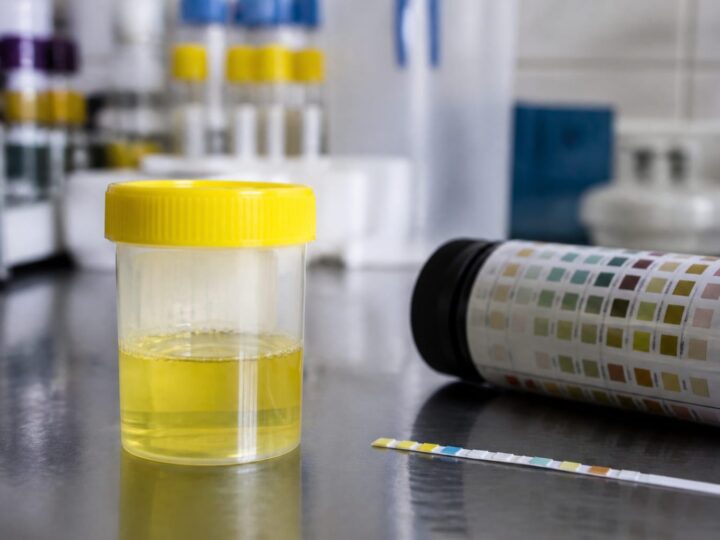Ce înseamnă proteinele în urină și când o valoare peste 3500 mg pe 24 de ore indică sindrom nefrotic