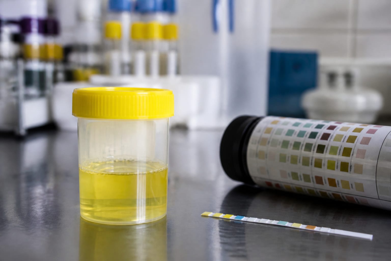 Ce înseamnă proteinele în urină și când o valoare peste 3500 mg pe 24 de ore indică sindrom nefrotic